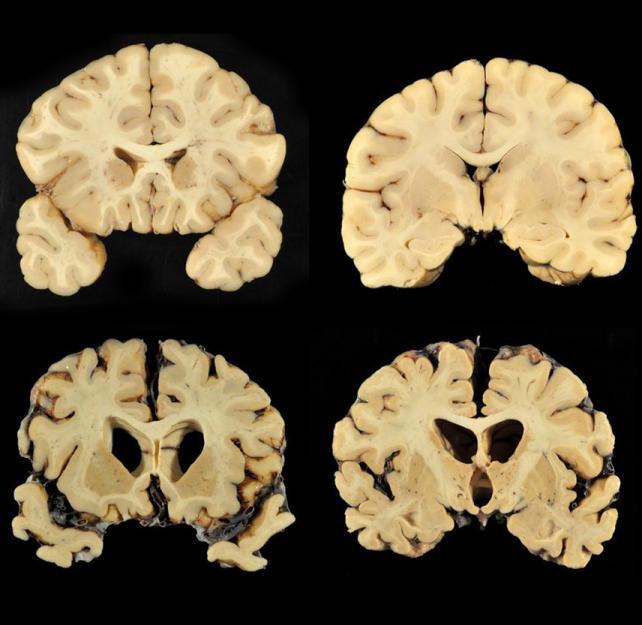 chronic-traumatic-encephalopathy-cte-brainline